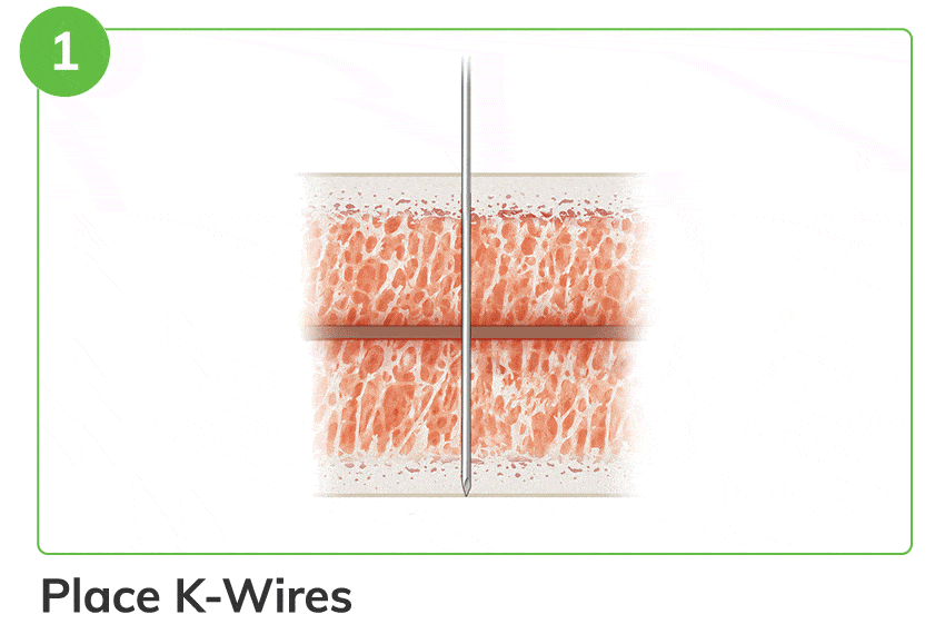 Ossio Can Trimmablenails Steps D 1 Ossio – Naturally Transformative Bone Healing