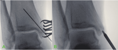 Dr Palmer Medial Malleous Fracture 2 Ossio – Naturally Transformative Bone Healing