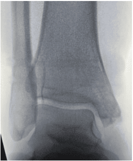 Dr Palmer Medial Malleous Fracture 4 Ossio – Naturally Transformative Bone Healing