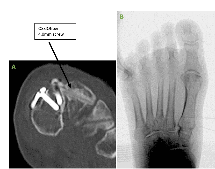 Screen Shot 2023 01 18 At 1.29.49 Pm Ossio – Naturally Transformative Bone Healing