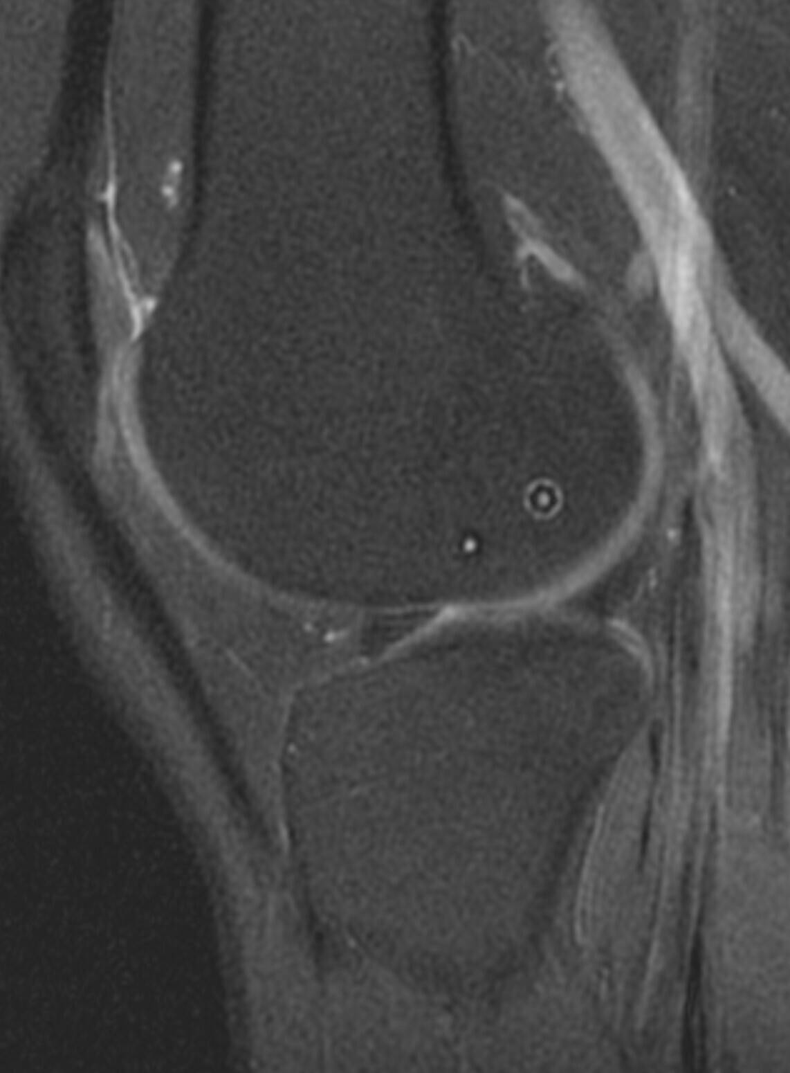 Kneebar™ Procedure 4 Post-Op Mri