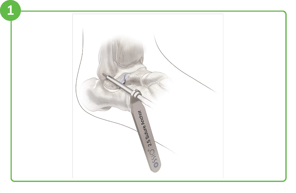 Ossiofiber® 2.5 Suture Anchor 10 Anchor Suture Animation Ossio – Naturally Transformative Bone Healing