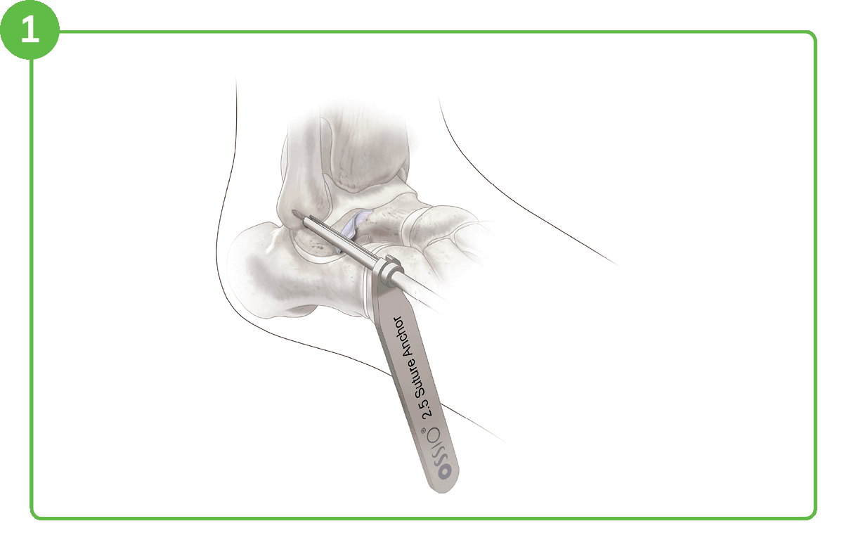 Ossiofiber® 2.5 Suture Anchor 12 The Better Brostrom Repair With 2.5 Suture Anchors Ossio – Naturally Transformative Bone Healing