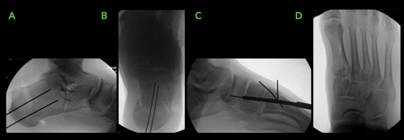 All-Natural Flatfoot Reconstruction 2 Flatfood Procedure Xrays Image Ossio – Naturally Transformative Bone Healing