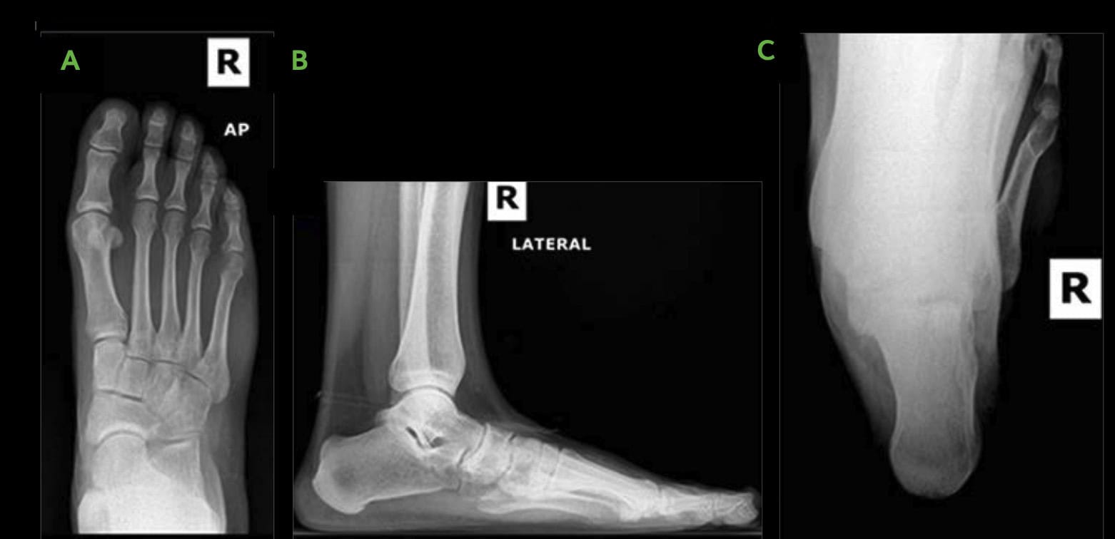 All-Natural Flatfoot Reconstruction 1 Flatfoot Procedure Image Ossio – Naturally Transformative Bone Healing