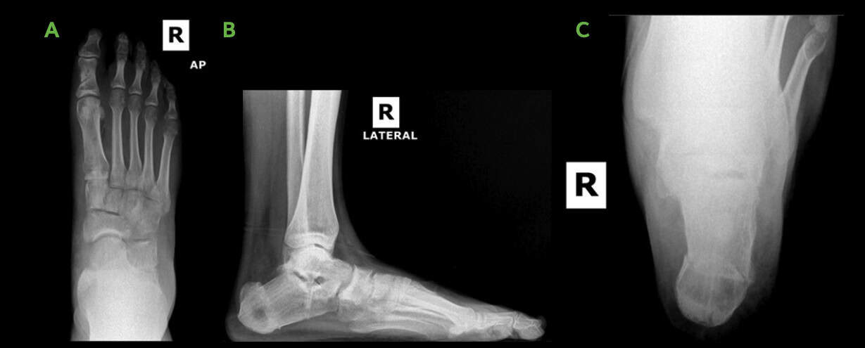 All-Natural Flatfoot Reconstruction 3 Post Op Flatfoot Procedure Image Ossio – Naturally Transformative Bone Healing
