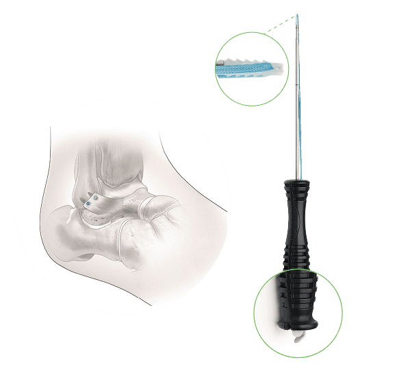 Brostrom Repair 1 Frame 272 Ossio – Naturally Transformative Bone Healing