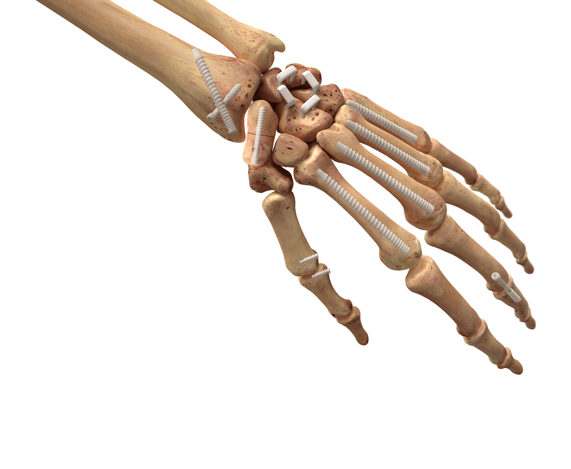 Handandallimplants 1 1 2 Ossio – Naturally Transformative Bone Healing