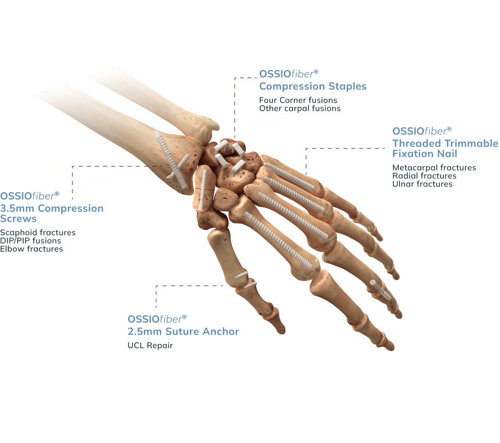 Hand Wrist Details Ossio – Naturally Transformative Bone Healing