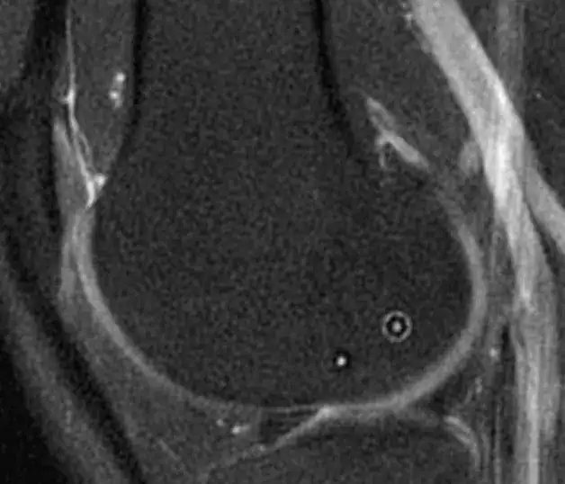 Kneebar Post Op Slice.png Ossio – Naturally Transformative Bone Healing