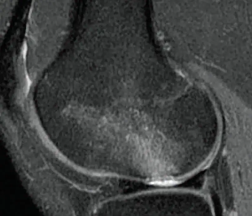 Kneebar Pre Op Slice Ossio – Naturally Transformative Bone Healing