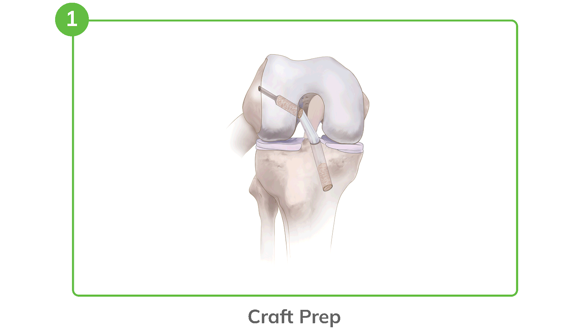 Ossio Reel Ossio – Naturally Transformative Bone Healing