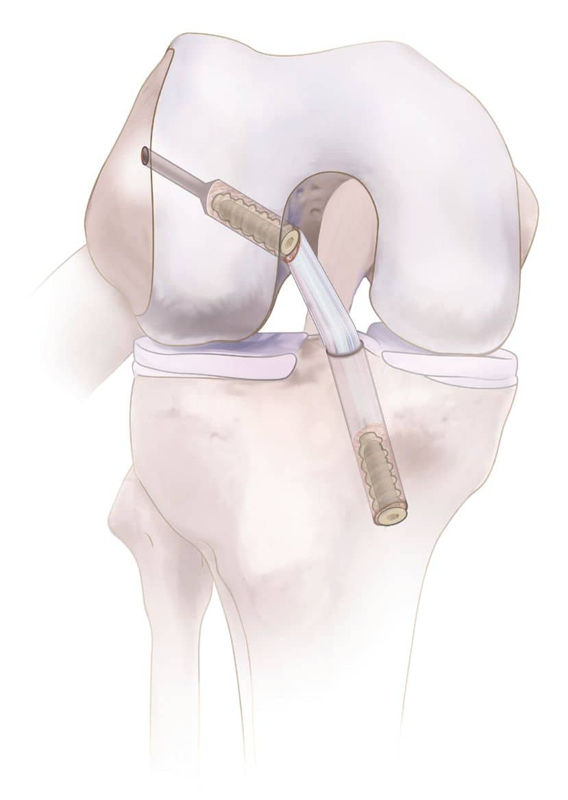 Ffe2061C58A8977C46D337E90Ee2A0527Bd6B71B Ossio – Naturally Transformative Bone Healing