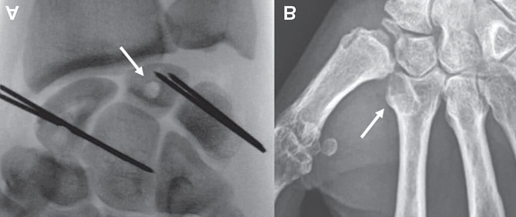 Key Observations From Published Literatureon Bone Response In Hand &Amp; Wrist Surgery