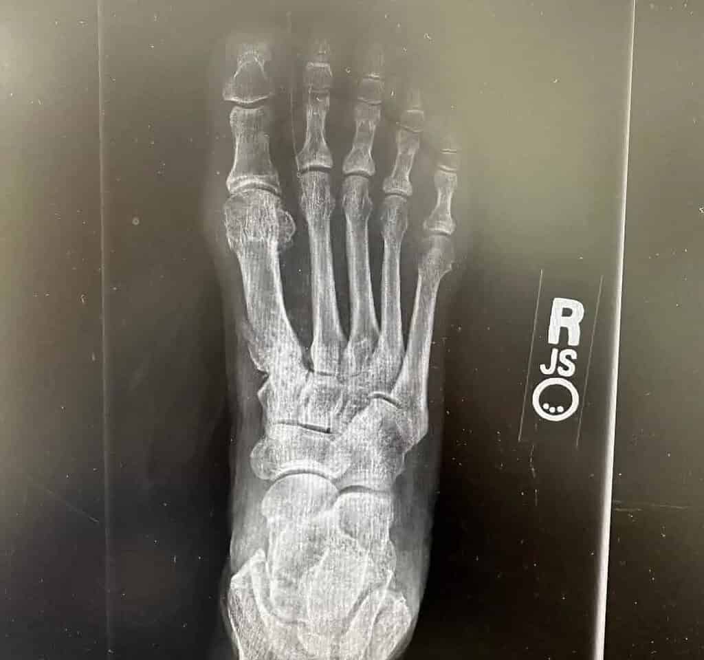 Foot &Amp; Ankle After
